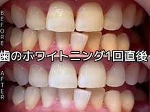 ヴィオール 名古屋栄店(VIOR)/最大8トーンup！ホワイトニング