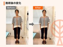 ただき接骨院 整体院 石原院/施術後の変化：肩こり・歪み