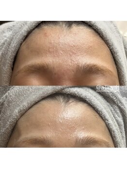 アリア(allia)/白ニキビ、毛穴のつまり