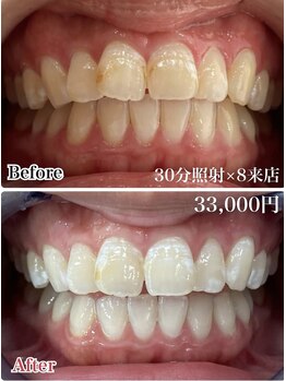 ホワイトニングスタイル 柏店/30分8来店 33000円