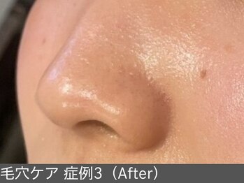 オアシスラグーン(OASIS LAGOON)/毛穴ケア(症例3:after)