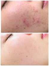 アンジェロ/【ニキビケア】肌育プログラム