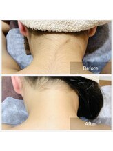 ノルン(Norn)/うなじ脱毛