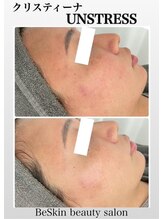 ビースキン 藤沢店(BeSkin)/季節の変わり目・急な肌トラブル