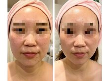 リアン(Riang)/最新スカルプフェイシャル