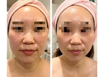 リアン(Riang)/最新スカルプフェイシャル