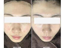 スキンベイビー 池袋店(Skin Baby)/【幹細胞ハーブピーリング】