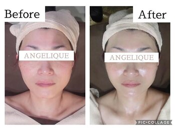 アンジェリーク/40代からの小顔矯正リフトアップ