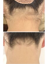 十美/ブライダルワックス脱毛