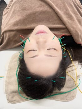 いおり鍼灸接骨院の写真/【女性鍼灸師の小顔術】深層アプローチでググっとリフトアップ！頭皮鍼×美容鍼で土台から整う理想の小顔へ