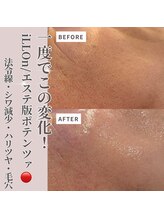クラルテアンドコー(Salon Clarte&Co.)/韓国エステ版ポテンツァ＃1回