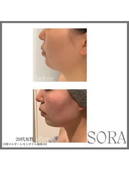 青空 天神大名店(SORA)/小顔コルギ＋レモンボトル3cc1回