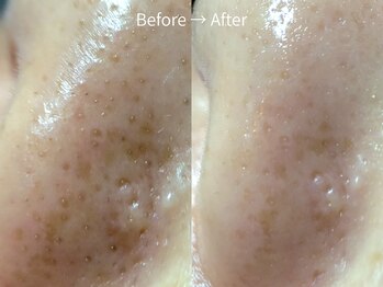 ルーチェ(LUCE)の写真/【ご新規様限定☆】鼻の黒ずみ・角栓ごっそり洗浄＋美容液導入でつるんと引き締まった毛穴へ￥7000