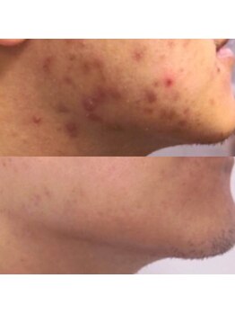 メンズサロンエヌエー(MEN'S SALON NA)/【肌質改善】光フェイシャル