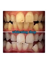 ホワイトニングショップ 所沢店/ホワイトニングショップ所沢店