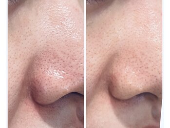 キュララ(KYURARA)/毛穴ケアは4コース◎どのタイプ?