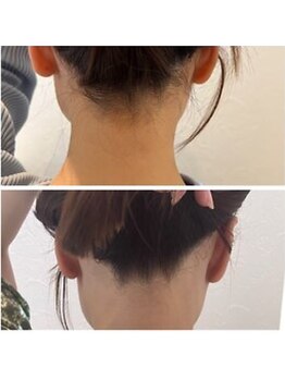 ミース 江坂店/ 矯正1回目でスッキリ