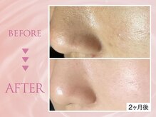 韓国式毛穴洗浄のBefore⇒After多数掲載中◎ララピール公認♪