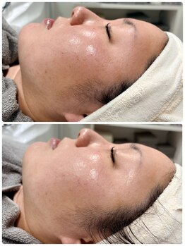 ウェイビーズ エステ(wavy's.esthetic)/【ビフォーアフター】ツヤ美肌