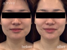 エムドット(M.)/エアバリフェイシャル