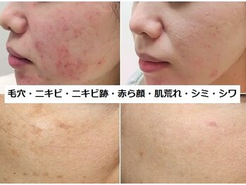 ナチュレアンドメディカ(Nature&Medica)の写真/エステ唯一のW美顔はトラブルを改善して美肌を生成！肌荒れ,赤ら顔,毛穴,シワ,シミ,ニキビを最新美容で改善
