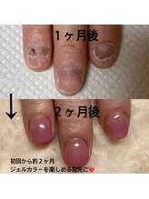 ミガクネイル(Migaku nail)/再来様深爪改善コース
