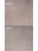 ピリナ(Pilina)/背中シェービング拡大