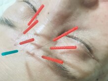 シフク鍼灸整体院/眉間のしわ改善