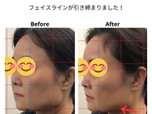 ベル/50代の方の小顔Before After