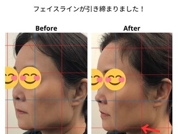 ベル/50代の方の小顔Before After