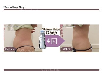 Nビューティー/最新エンダモロジーBODY