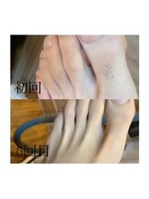 カウピリ(kaupili)/【脱毛】ビフォーアフター