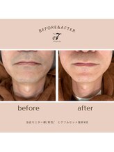 ナナ(nana)/◆before/after◆