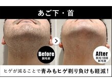 RBL ゆめタウンサンピアン熊本店/メンズ脱毛/ヒゲ脱毛1回目剃毛後