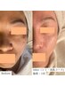 【【全顔シミ美肌No.1】IPL光フォト＋RF同時照射   都度払い　15,400円
