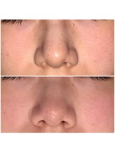 ラキア 五位堂駅前店(Ra kia)/毛穴ケア