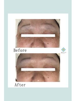 エステティックルーム サリ(Aesthetic Room SARI)/シミ改善ビフォーアフター♪