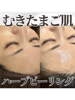 ミタメ 銀座店(MITAME)の写真/【口コミ4.9★】即日たまご光肌★ハ-ブピ-リングが大人気！美人になれる♪小顔/ツヤ美肌/肌改善