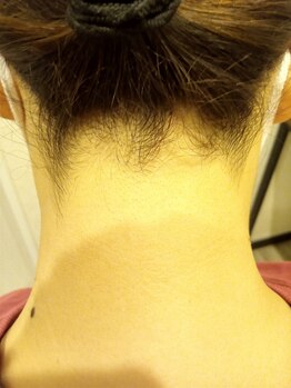 ミライズ(MIRAI'S)/うなじ脱毛→お得な毎回同価格♪