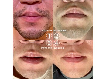 ジェムの森/ひげ脱毛 before after写真