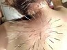 【首肩こりにお悩みの方★】　ルート鍼　45分