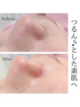 ユニクリア(Uni clear)/毛穴洗浄ピーリング