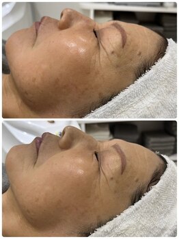 ウェイビーズ エステ(wavy's.esthetic)/ビフォーアフター】毛穴ケア