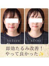 スウ(suu.)/Before-After【30代】1回
