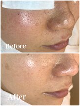 ウエカ(ueka)/20代　全顔エクストラクション