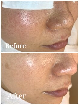 ウエカ(ueka)/20代 全顔エクストラクション