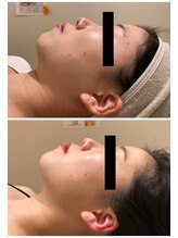 エイシスグロウ(asis glow.)/効果写真