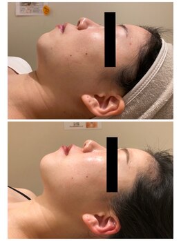 エイシスグロウ(asis glow.)/効果写真