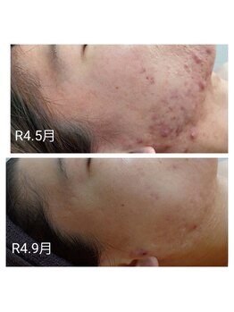 ビラ ベルダ(Bira Beldad)/ニキビケア