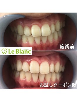 ルブラン 奈良店(Le Blanc)/自然で清潔感のある歯に!